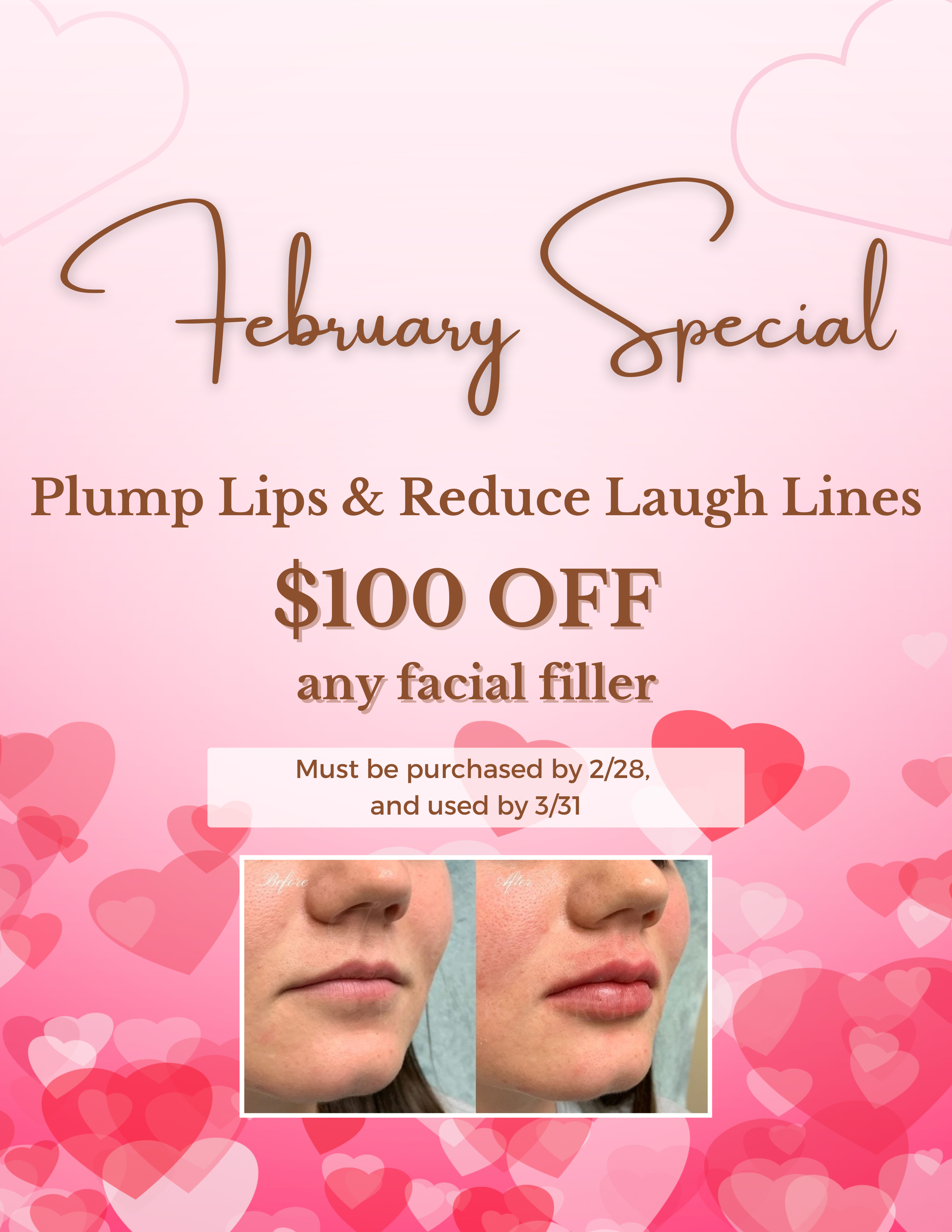 February Special - Facial Filler