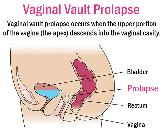 Pelvic Organ Prolapse - Philadelphia, PA: Gynecology Specialists of  Philadelphia