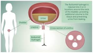 Bulkamid for Incontinence