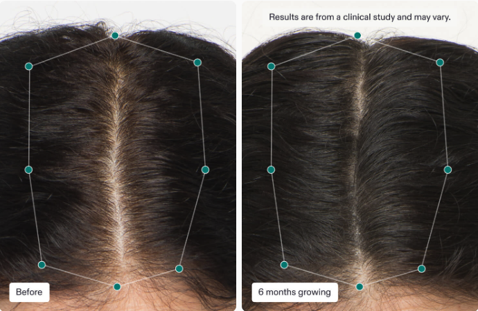 FPH Center - Nutrafol hair growth supplement before and after