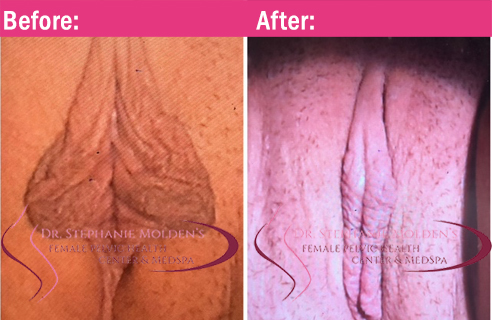 1Female Pelvic Health Center (Newtown PA) - Labiaplasty Before and After