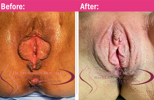 3Female Pelvic Health Center (Newtown PA) - Labiaplasty Before and After