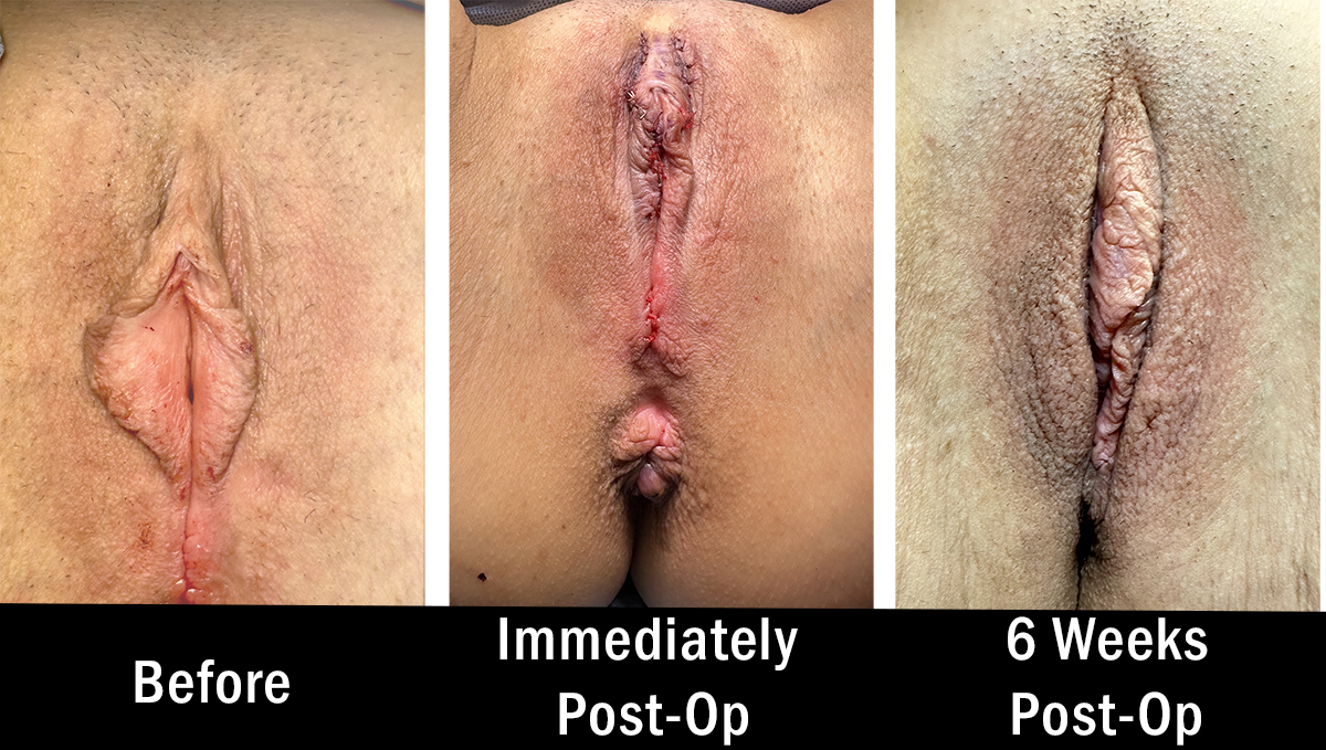 Female Pelvic Health Center (Newtown PA) - Labiaplasty Before and After