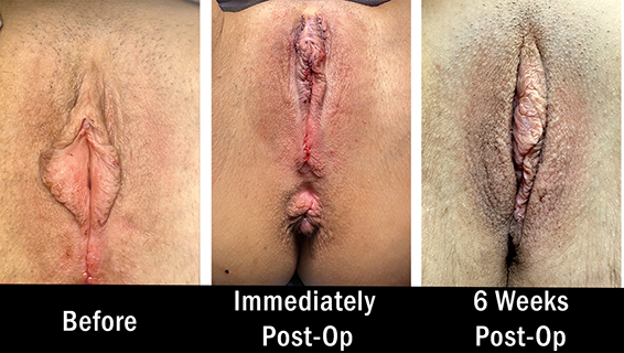 Female Pelvic Health Center (Newtown PA) - Labiaplasty Before and After